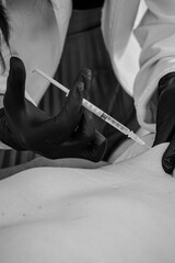 Sao Paulo, SP, Brazil - July 29 2024: Black and white close-up photograph of an aesthetic procedure for localized fat details.
