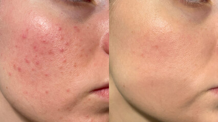 Before and After Skin Transformation: Close-Up Macro Shot of Acne-Prone Face to Clear, Radiant, and Beautiful Skin – Natural Skin Care, Dermatology, and Acne Treatment Results for Healthy Glowing 