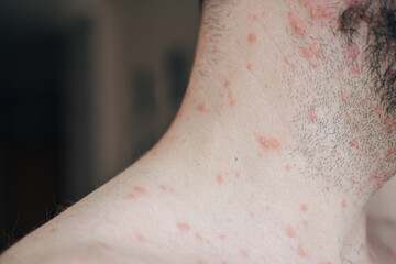 Adult man neck and body with strong aggressive varicella or chicken pox. Pink spots, papules,...