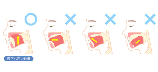 正しいミューイングの方法　適正な舌の位置と誤った舌の位置 © koti