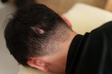 円形脱毛症の男性