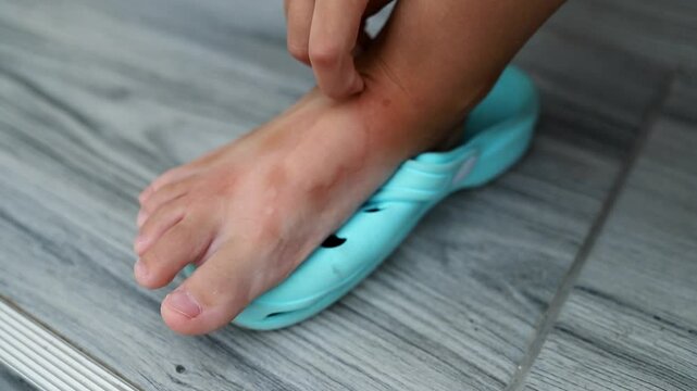 Child scratching foot with redness from mosquito bite, skin irritation.