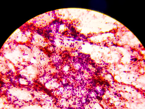 Parotid swelling cytology, Monomorphic adenoma. Smear show cellular material of epithelial cells in clusters and singly on the background of blood