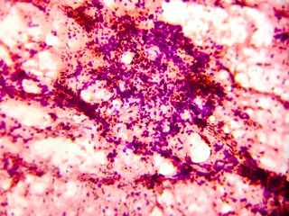 Malignant cells, bronchoalveolar lavage (BAL) adenocarcinoma. Microscopic show cellular material...