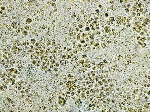 Pyuria or leukocyturia is the condition of urine containing white blood cells or pus. It can be a sign of a bacterial urinary tract infection