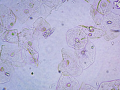 Epithelial cells with bacteria in patient urine (urinary tract infections). Analyze by microscope. Contrast adjustment.