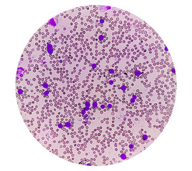 Leukemia, blood cells, blast cells and immatured leukocytic cells in chronic myelomonocytic leukemia, 1000x
