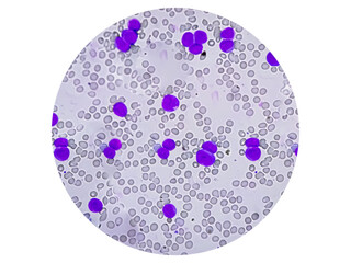 Acute myeloid leukemia (AML) is a type of blood cancer. Microscopic examination of blasts or leukemia cells in blood smear of human.