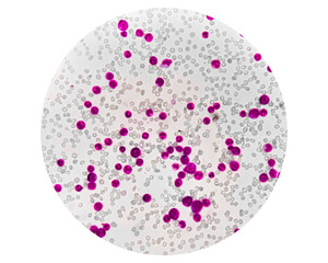 Acute leukemia, ALL (Acute lymphoblastic leukemia), peripheral blood smear, Under 100x light microscope to diagnosis of Acute leukemia.