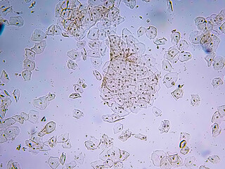 Epithelial Cell Casts in urine analysed by microscope. Epithelial cell, Pus cell. 40X