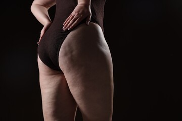 Naklejka premium Woman with cellulite problem on black background, closeup. Space for text