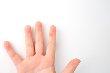 A close-up view of finger with wart. The background is plain white, for dermatology and skin health...