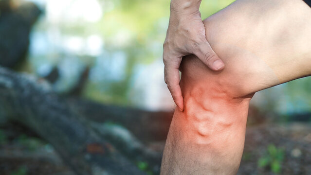Varicose veins on the legs of men