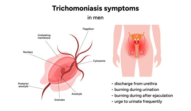 Trichomonas Vaginalis parasites zoom. Men and women infection disease. Trichomonas symptoms in man