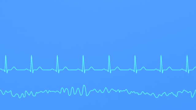 Normal heart rhythm ECG and ventricular fibrillation