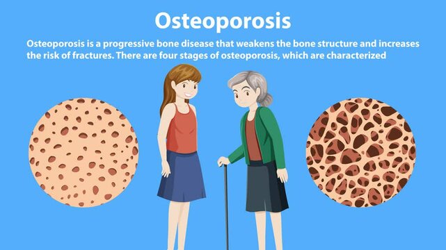 Understanding Osteoporosis Progression