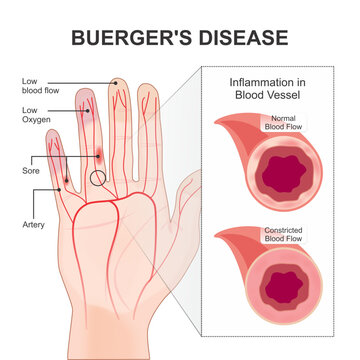 Buerger's Disease constricted blood flow illustration