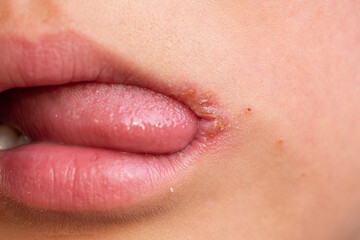 Close-up of a child with dry lips and a bloody lip crack.