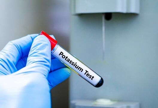 Blood sample tube for potassium test analysis.