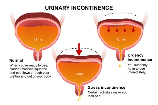 Urinary Incontinence urine leakage illustration
