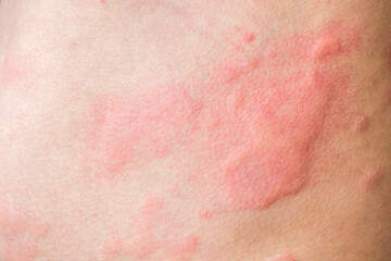 Skin allergy rash dermatitis texture close up background