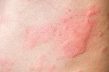 Gordijnen Skin allergy rash dermatitis texture close up background © Kwangmoozaa