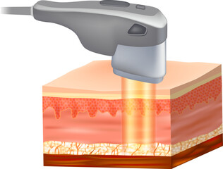 Ultrasonic SMAS lifting or HIFU lifting. Gold Laser Procedure. Ultrasound Skin Tightening and Anti-Aging Technology. Deep Tissue Skin Rejuvenation