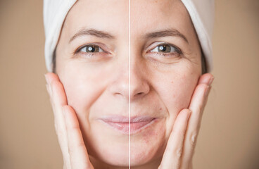 Collage with photos of mature woman before and after cosmetic procedure