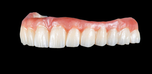 zirconium bridge on implants