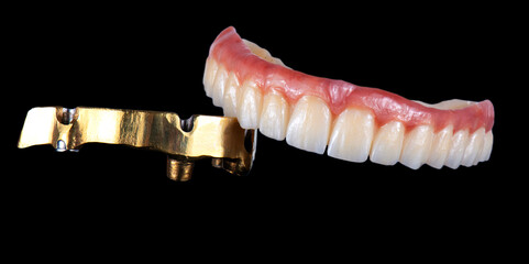 zirconium bridge on implants