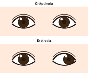 外斜視と正常な目の比較イラスト（Strabismus/Exotropia）