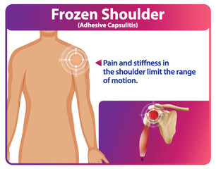 Understanding Frozen Shoulder Symptoms