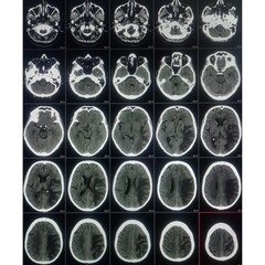 CT scan of brain, Intraventricular hemangioma with adjoining periventricular seepages and herniation.