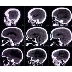 CT scan of brain, Intraventricular hemangioma with adjoining periventricular seepages and...