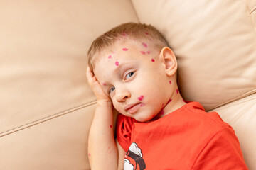 Young boy with chickenpox smiling while leaning on a couch in a cozy indoor setting during daytime