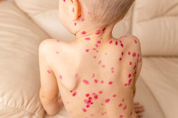 Child with visible chickenpox rash sitting on sofa during daytime in a well-lit room