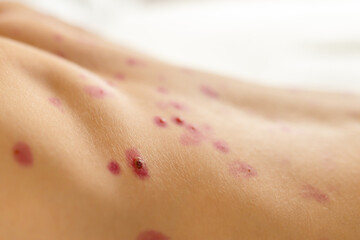 Skin with red spots showing signs of irritation or allergic reaction on a person's back in a...