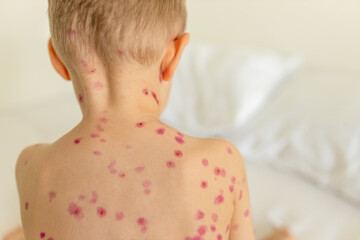 Child with visible chickenpox rash sitting on bed during daytime in a well-lit room
