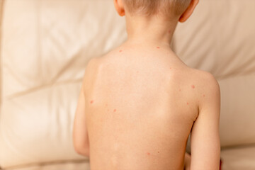 Chicken pox (varicella). Contagious disease. Sick child with chickenpox. Varicella virus or...