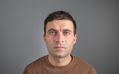Caucasian man after eleven month hair transplantation.