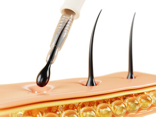 3d hair transplant fue method render banner. Scalp with follicles and medical instrument, implantation of graft in channel. Baldness treatment, transplantation and restoration concept. 3D illustration