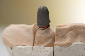 Frames of ceramic-metal  crowns on the stand of the articulator