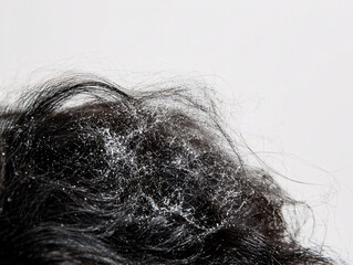 Fototapeta premium Close-up of unkempt dark hair with visible dandruff flakes scattered throughout emphasizing hair and scalp care concerns 
