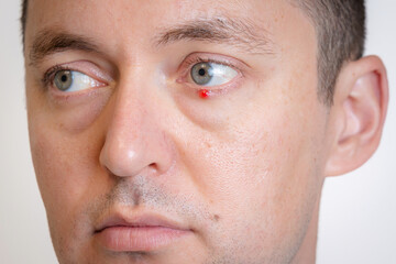 Obraz premium Man's eyes with pus redness like chalazion caused by blocked sebaceous glad on lower eyelid. Hordeolum. Viral infection