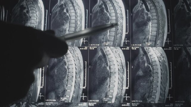Doctor Pointing at Spine MRI Scan Images on Medical Viewbox, Spinal Column X-Ray Analysis with Pen in Hand