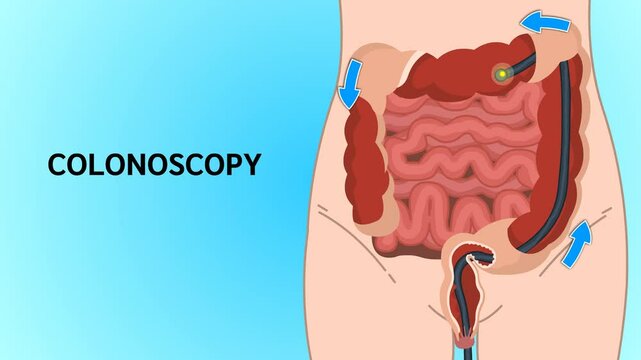Colonoscopy is a medical procedure used to examine the inner lining of the colon and rectum using a flexible, fiber-optic camera.