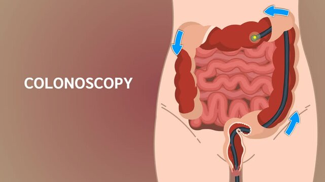 Colonoscopy is a medical procedure used to examine the inner lining of the colon and rectum using a flexible, fiber-optic camera.