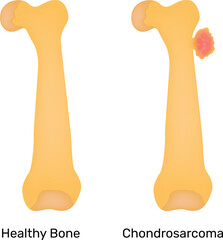 Healthy Bone Chondrosarcoma Science Design Vector Illustration Diagram