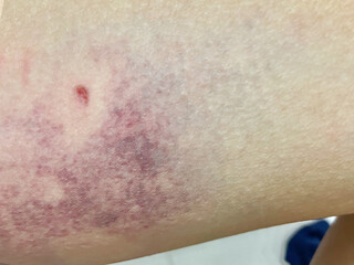 detail of a dog bite wound on a leg. Dog Bite Wound on Caucasian Leg Bloody Punctures and Purple Bruising