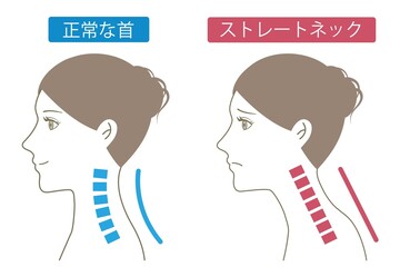 ストレートネック　ビフォアアフター